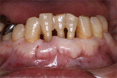 骨の吸収が著しい下顎前歯部の3本