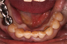骨の吸収が著しい下顎前歯部の3本