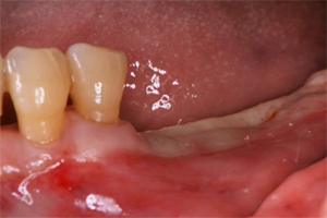 抜歯した下顎左側臼歯部にインプラント2本を埋入
