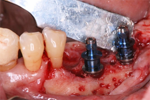 抜歯した下顎左側臼歯部にインプラント2本を埋入