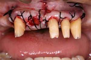 抜歯と歯周外科処置