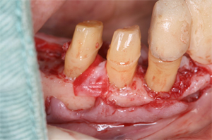下顎右側臼歯部